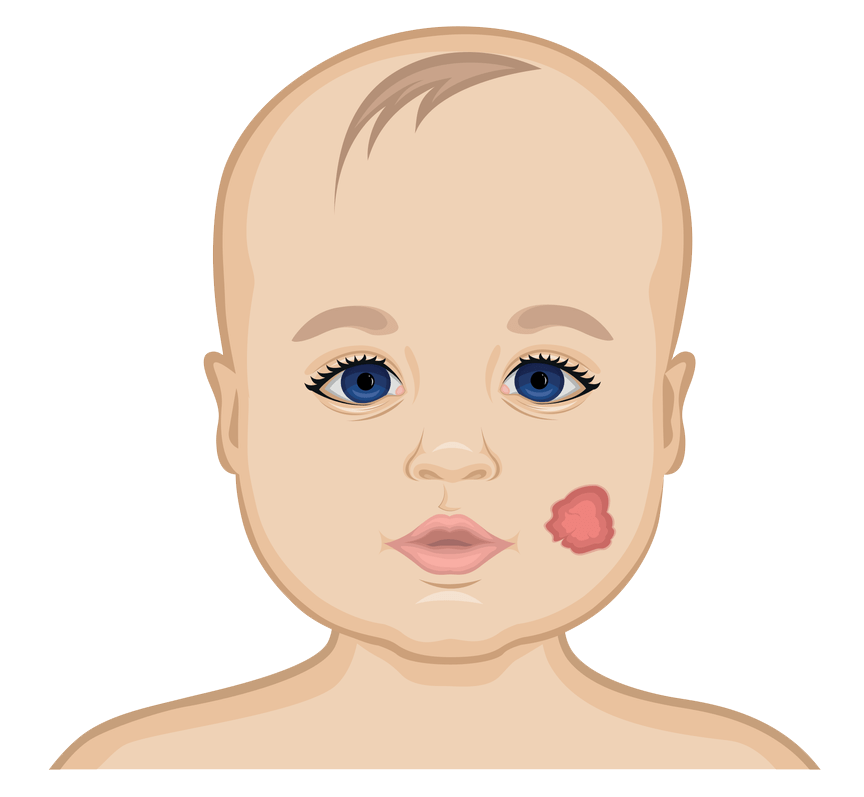توده روی بدن کودک
