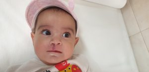 جراحی شکاف لب