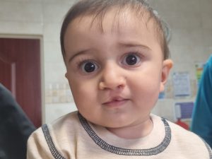 بعد از عمل جراحی لب شکری