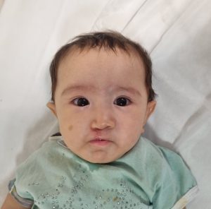 شکاف کام یک طرفه