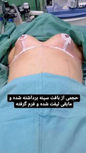 ماموپلاستی1