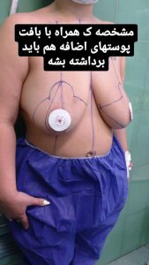ماموپلاستی2